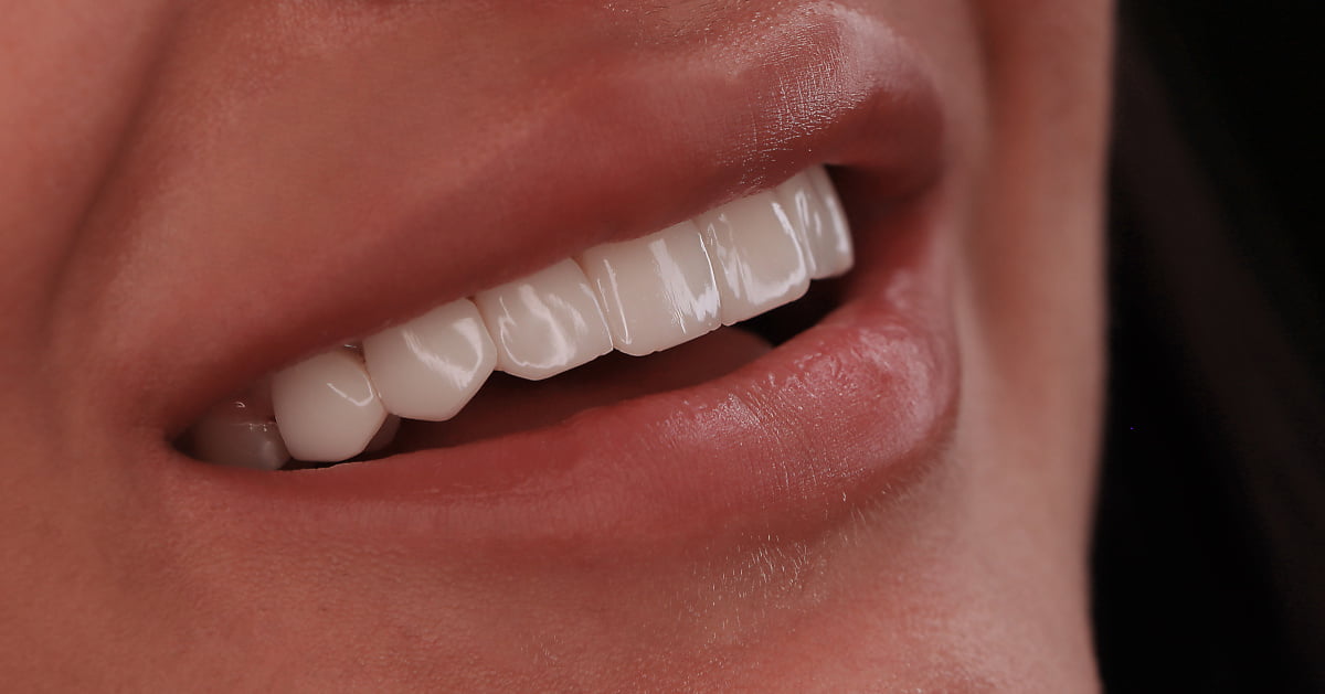 اصلاح کامپوزیت دندان