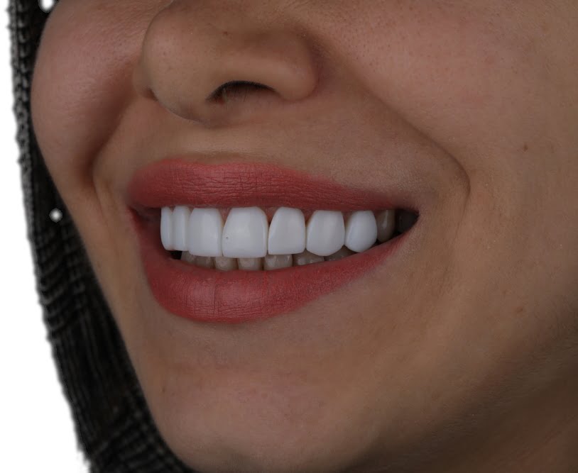 کامپوزیت سرامیکی دندان