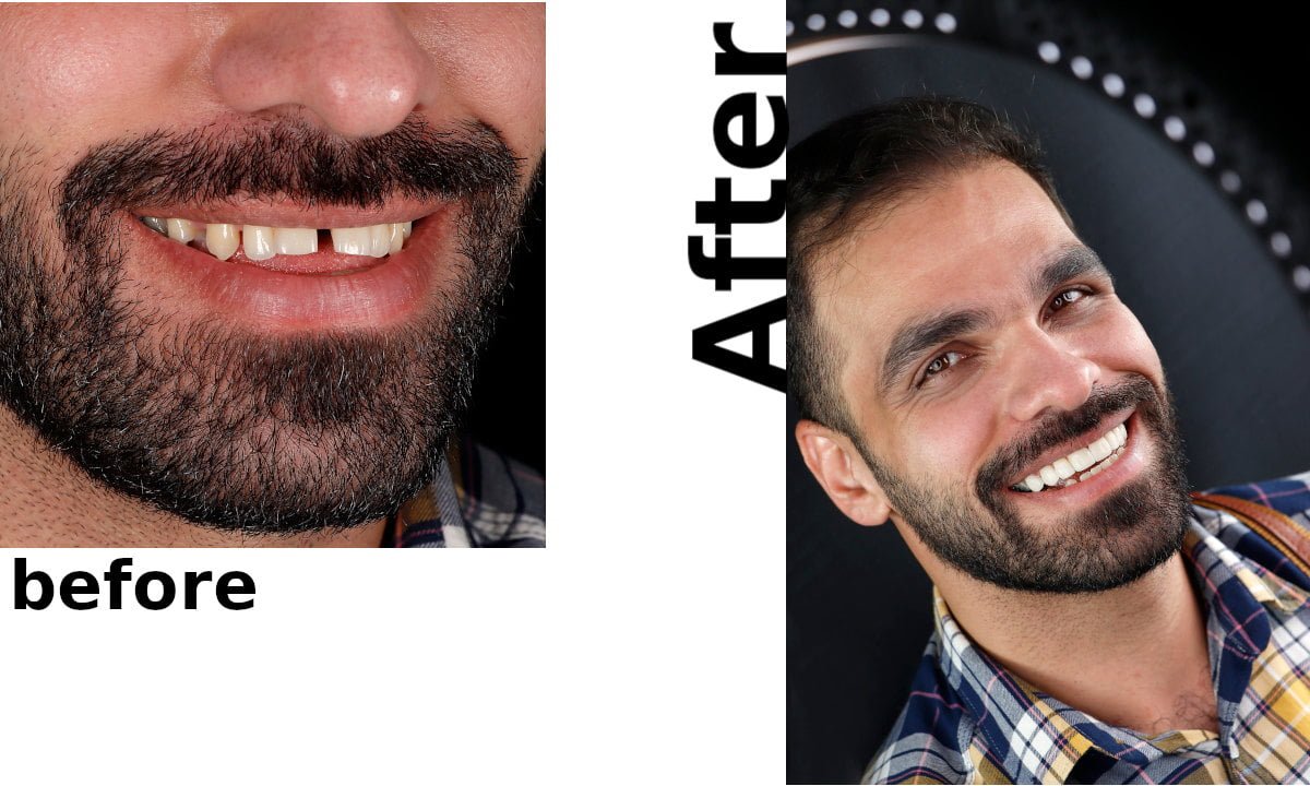 نمونه کار پر کردن فاصله بین دندان کلینیک دندانپزشکی عرشیان