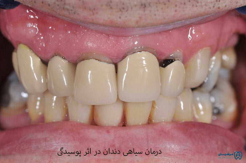 علت سیاه شدن دندان های جلو 