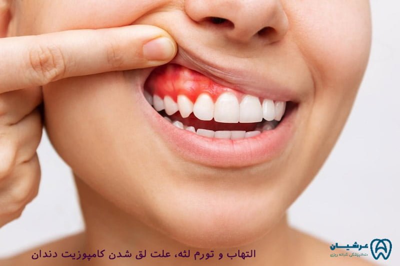 علت لق شدن کامپوزیت دندان