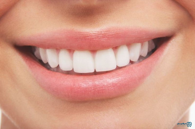 سفید شدن دندانهای زرد در یک روز 