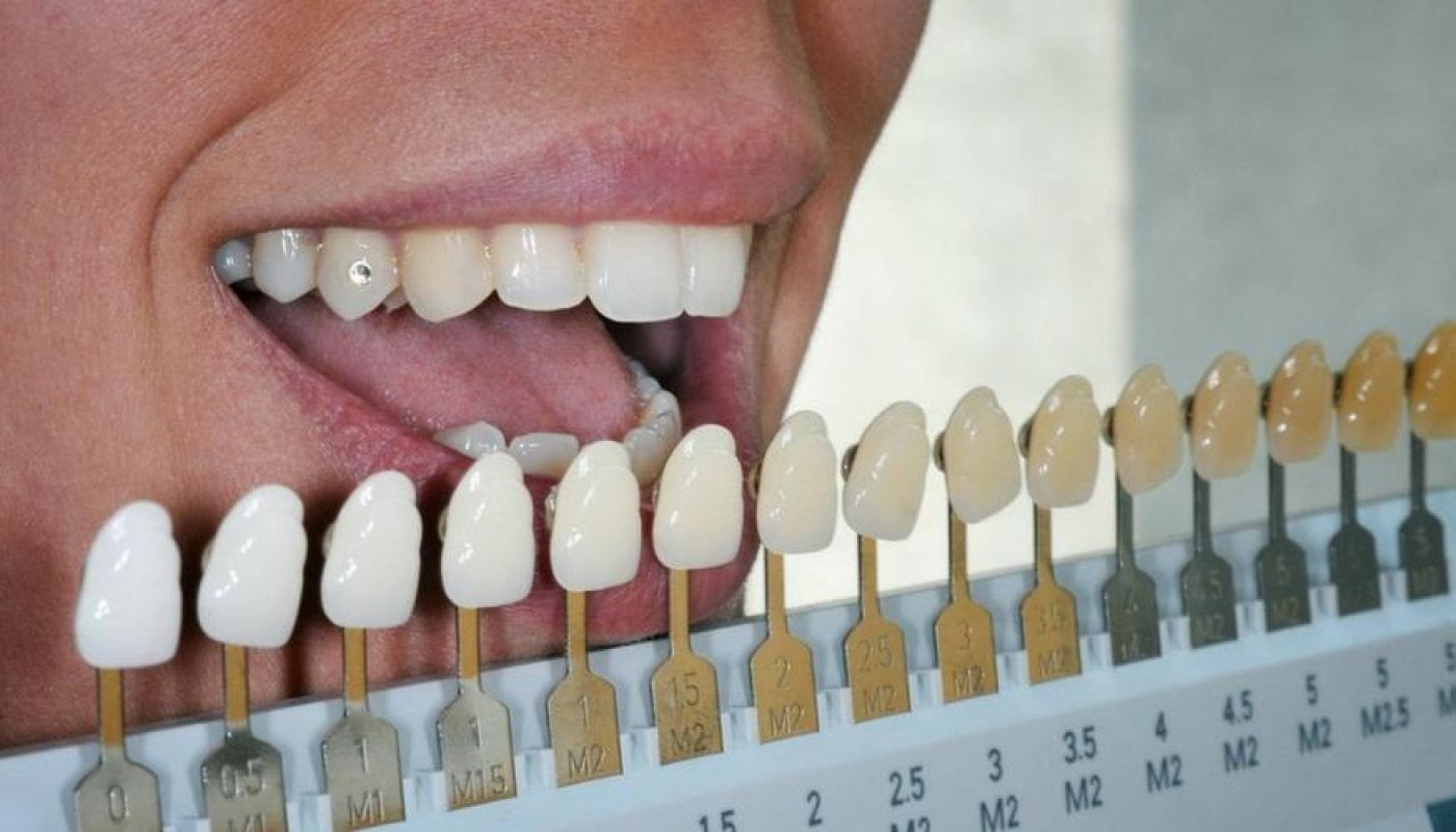 سفید ترین رنگ کامپوزیت دندان