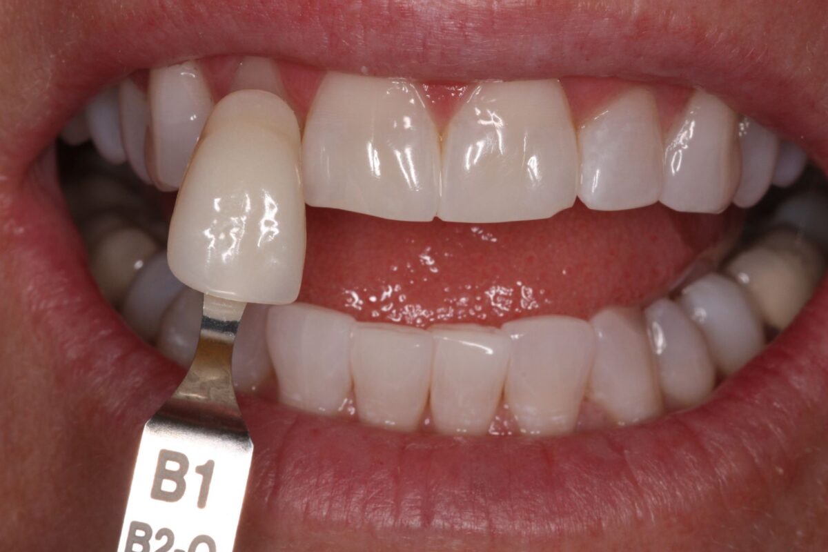 رنگ کامپوزیت دندان b1
