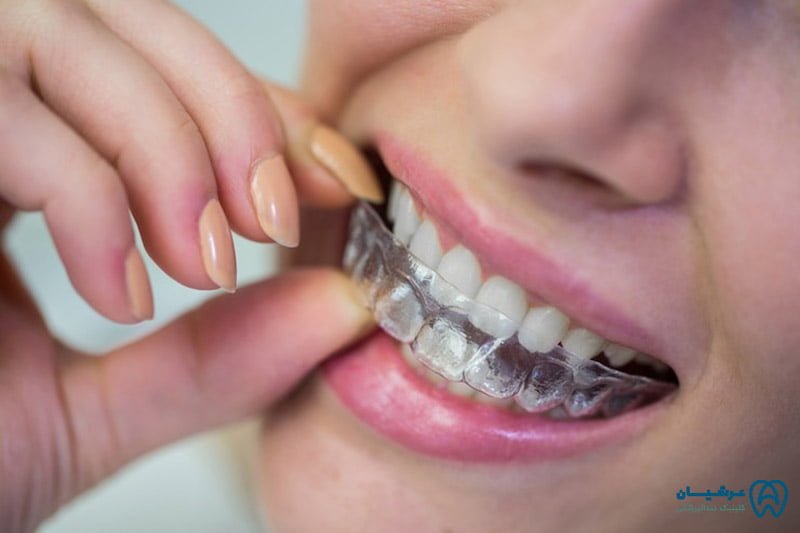 فواید و عوارض بلیچینگ دندان