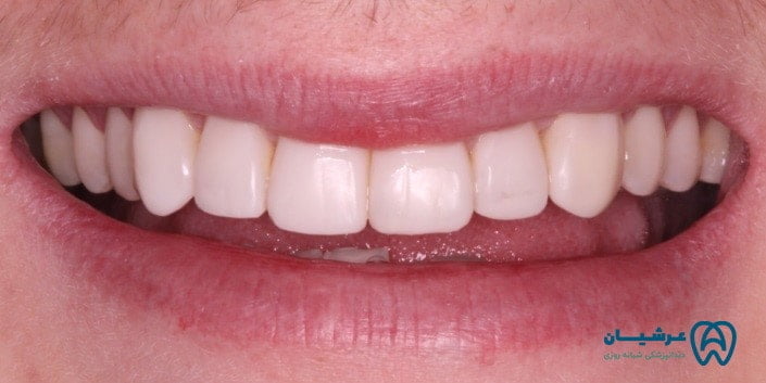 طبیعی ترین رنگ کامپوزیت دندان