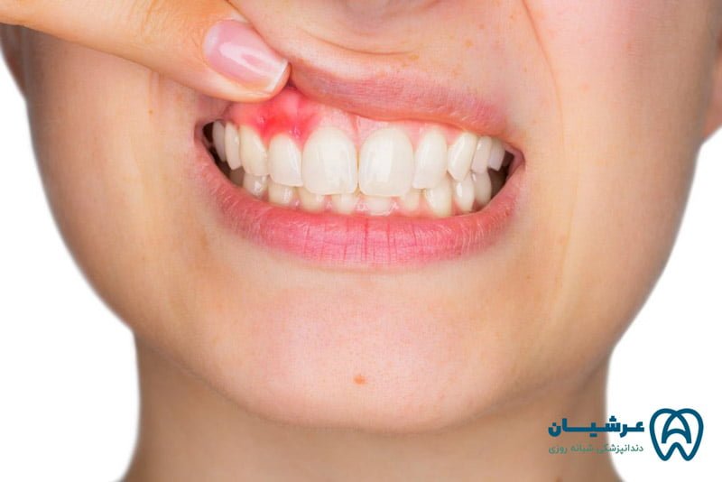 جراحی ریشه دندان عفونی
