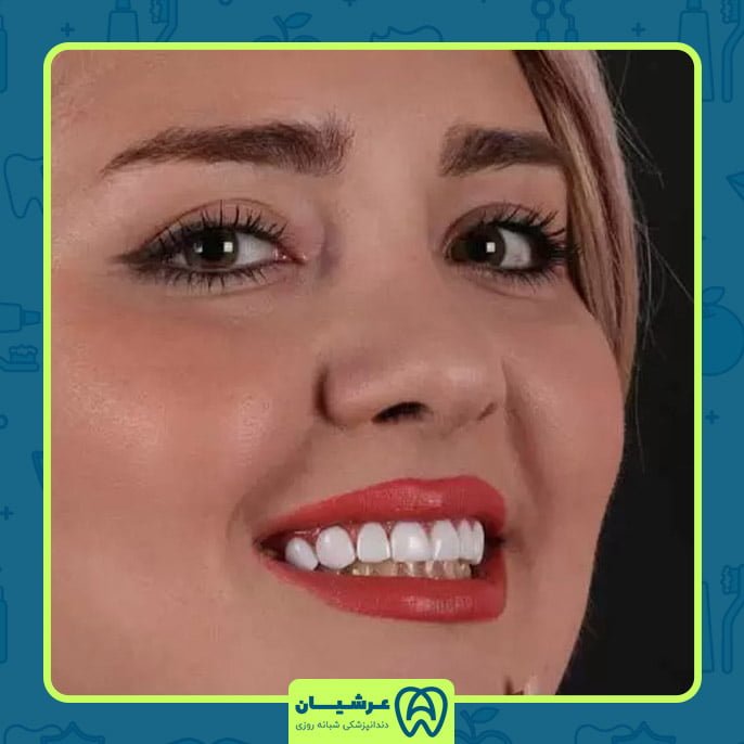 لمینت دندان تا چند سال دوام دارد؟
