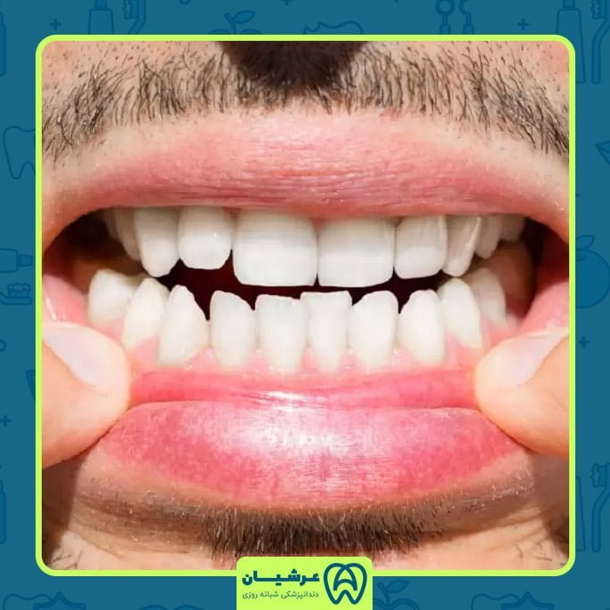 آیا جرم گیری دندان درد دارد؟