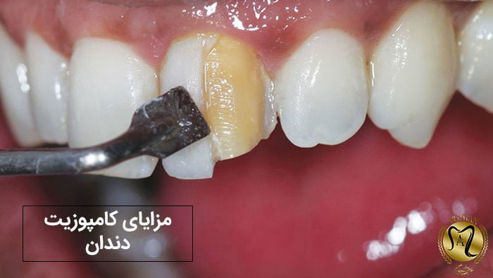 کامپوزیت دندان در هفت حوض