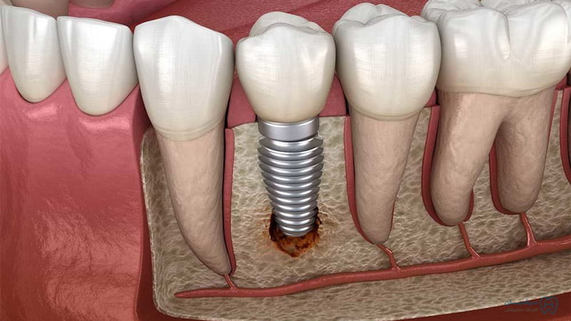 هر واحد ایمپلنت چند دندان است