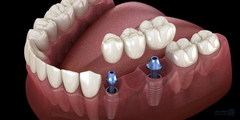هر واحد ایمپلنت چند دندان است