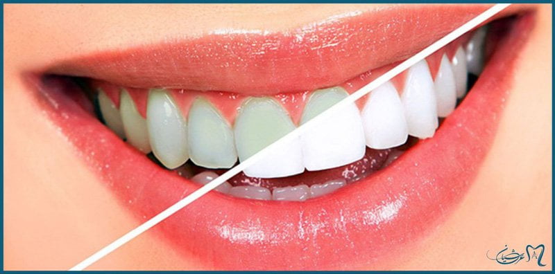 سفید کردن دندان با لیزر