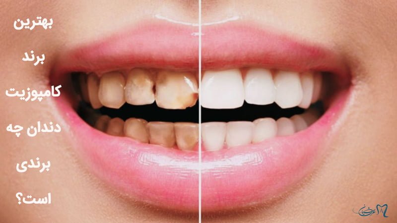 بهترین برند کامپوزیت دندان چه برندی است؟
