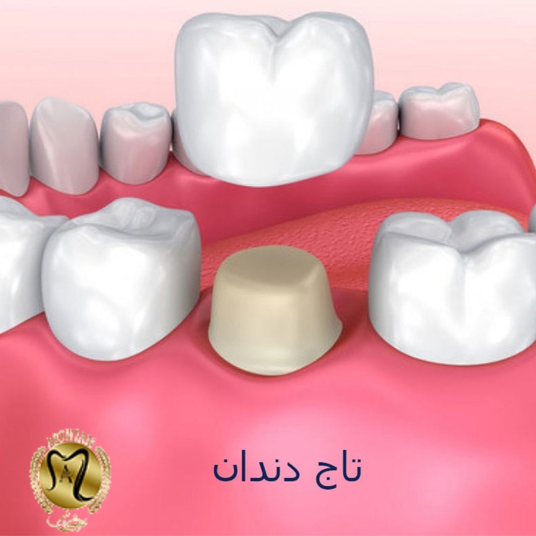 لمینت دندان یا تاج دندان ؟