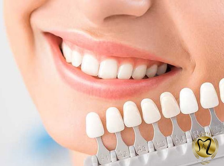 سفیدترین رنگ روکش دندان