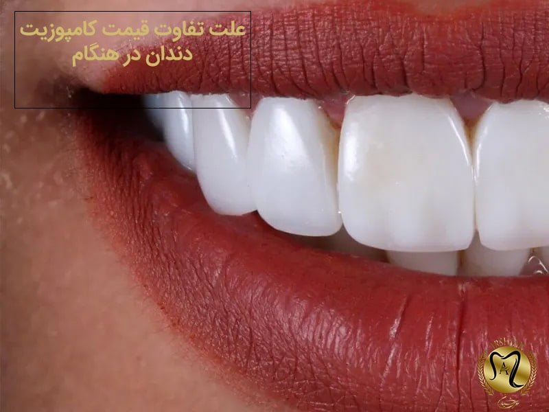 کامپوزیت دندان در هنگام