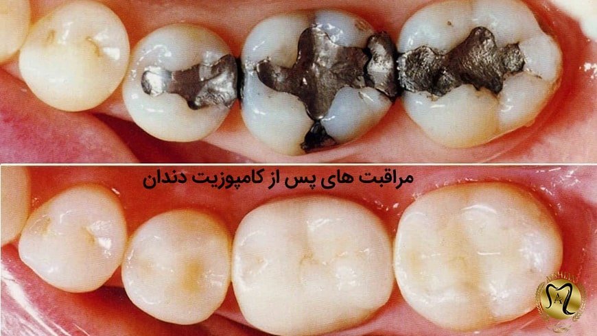 کامپوزیت دندان در هنگام