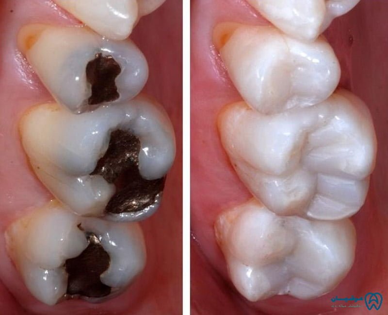 پر کردن دندان جلو با مواد سفید