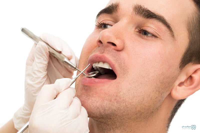 قیمت پر کردن دندان با عصب کشی