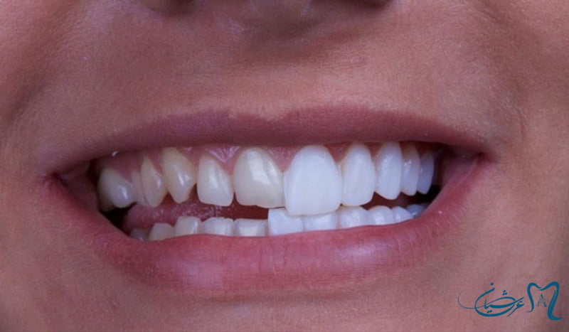 ایا کامپوزیت باعث خرابی دندان میشود؟