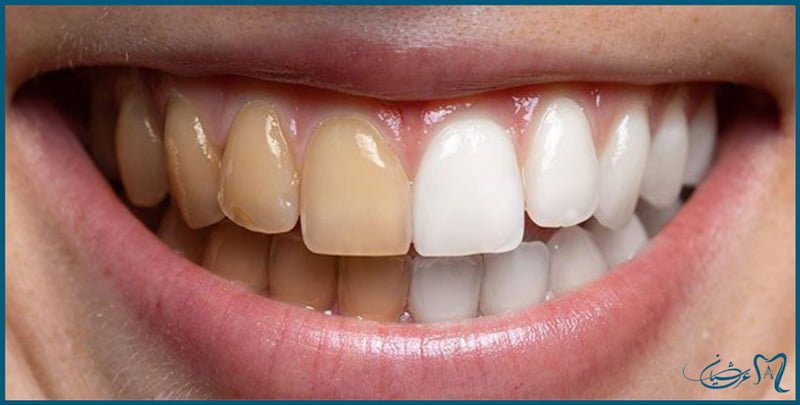 ویژگی های سفید کردن دندان با لیزر