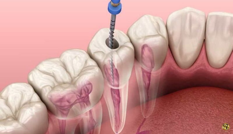 عصب کشی دندان در دوران شیردهی