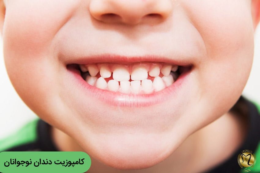 کامپوزیت دندان برای نوجوانان