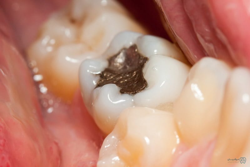 پر کردن دندان با مواد سیاه یا سفید