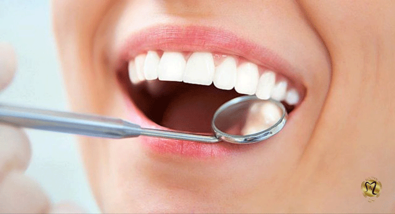 پیج کامپوزیت دندان