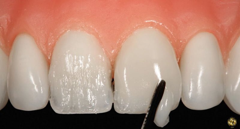 کامپوزیت دندان به روش لیرینگ چیست؟