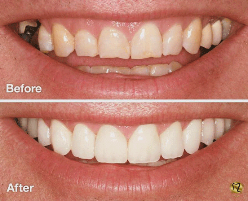 پیج کامپوزیت دندان