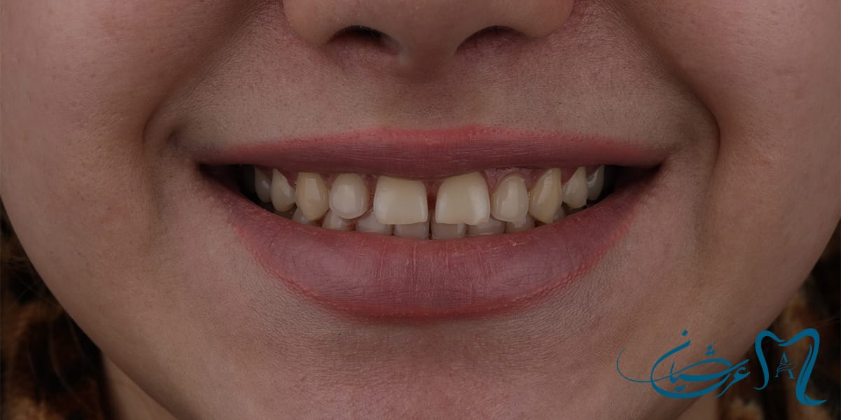 بستن دیاستم (فاصله بین دندانی) کامپوزیت برند کاریزما bl - قبل