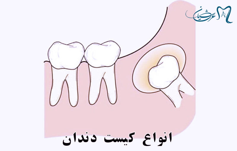 درمان فوری کیست دندان