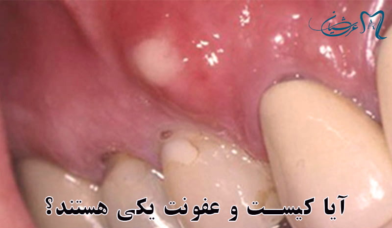 درمان فوری کیست دندان
