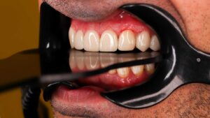 معرفی 5 برند برتر کامپوزیت دندان
