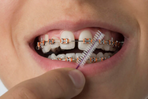 سوالات متداول ارتودنسی دندان 4