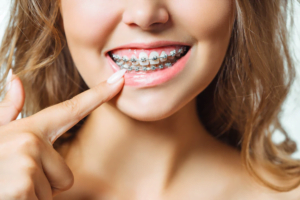 سوالات متداول ارتودنسی دندان 3