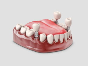 راهنمای ایمپلنت دندان 4
