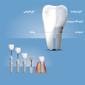 راهنمای ایمپلنت دندان 2 