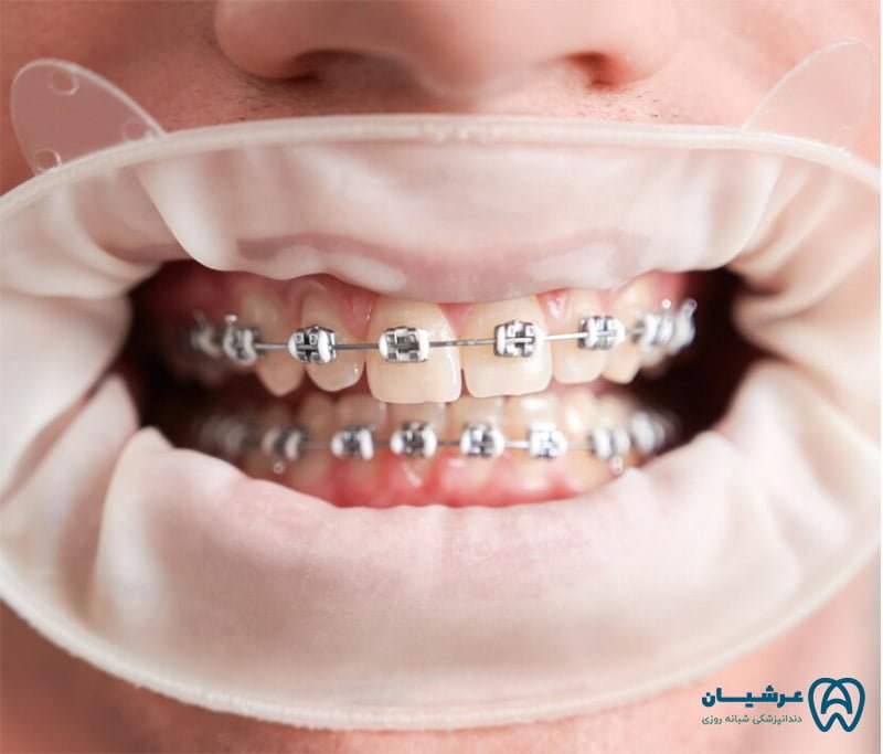 ارتباط میزان کج بودن دندان ها با مدت زمان ارتودنسی