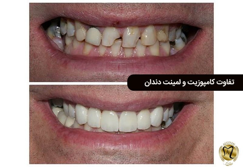 تفاوت کامپوزی و لمینت دندان