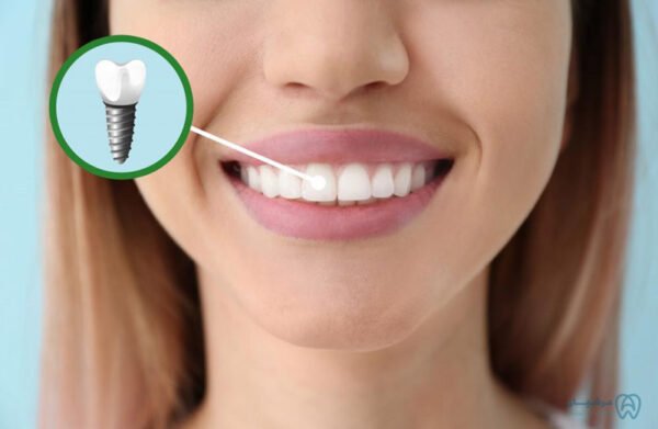 ایمپلنت دندان کلینیک عرشیان