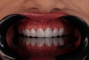 کامپوزیت دندان سارمکو