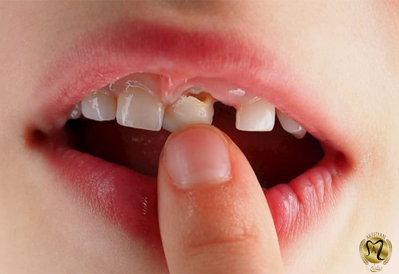 درمان لق شدن دندان