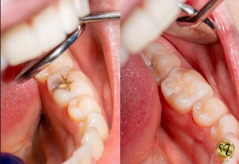 پر کردن دندان بلافاصله بعد از عصب کشی