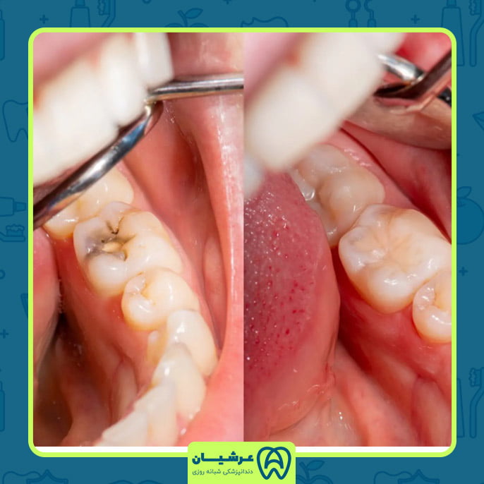 پر کردن دندان بلافاصله بعد از عصب کشی