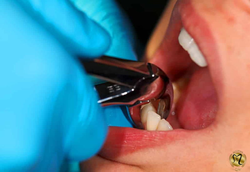 کشیدن کدام دندان درد بیشتری دارد