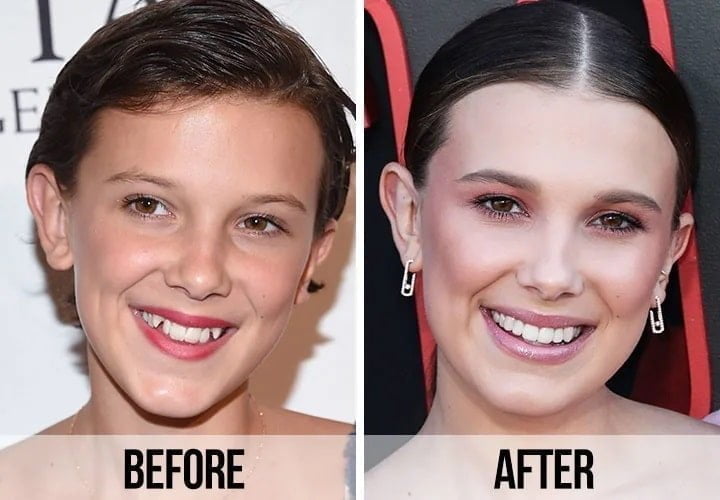 کیتی هلمز با دندان کامپوزیت قبل و بعد