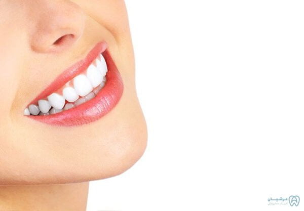 لمینیت دندان کلینیک عرشیان